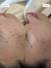 ブレデ フクオカ(B’lady Fukuoka)/黒いポツポツ毛もしっかり除去！