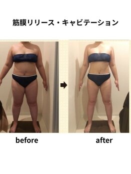 クリア(Clear)/筋膜リリース・キャビテーション