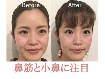 ラプリボヤージュ 藤沢店(Raplit)/隆鼻＋輪郭矯正40分10回