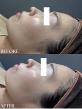 ルネ(Renee)/プラチナピーリング★1回の変化