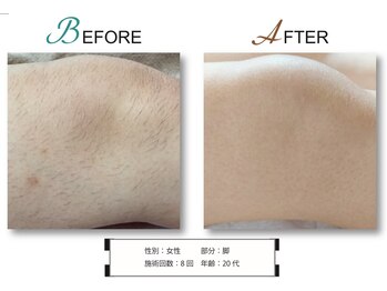 ココロ(KoKoRo)/VICTORIA 脱毛8回