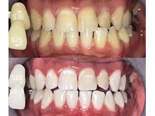 ペルレ(Perl)/本格ホワイトニング5回終了後