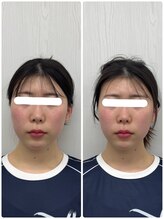 ラフテル鍼灸整骨院/ニキビケアに美容鍼！西長堀駅近