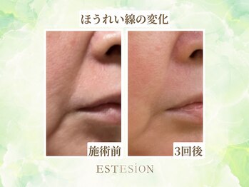エステシオン(ESTESiON)/ほうれい線の変化