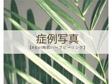 リノア 柏(Lino'a)/REVI陶肌トリートメント肌質改善
