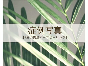リノア 柏(Lino'a)/REVI陶肌トリートメント肌質改善