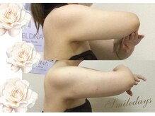 スマイルデイズ(Smiledays)/弾丸！10日間で4回！