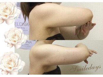 スマイルデイズ(Smiledays)/弾丸！10日間で4回！