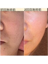 トラレス(Trouless)/