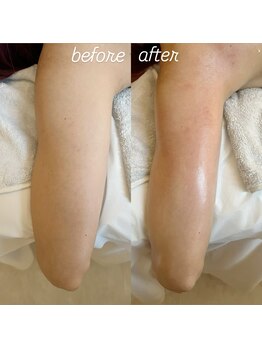 グレアージュ(GLEAGE)/全身痩身凹凸脂肪コース!