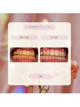 プラスビーセルフ(+b self)/ホワイトニングビフォーアフター