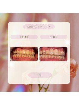 プラスビーセルフ(+b self)/ホワイトニングビフォーアフター