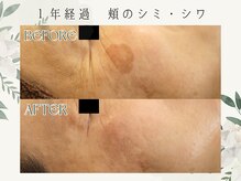 ラフラフ(Laf Laf)/光フェイシャル