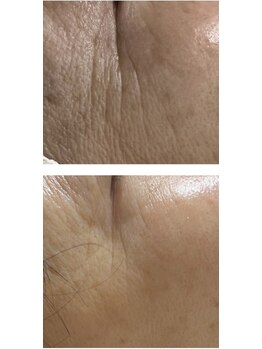 ジョアン(Johan)/世界特許★エンダモフェイシャル