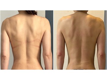 モア(moa)/背面の凝り、ハリがすっきり