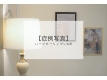 ライム 浦和(LIME)/ハーブピーリングBefore After
