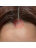 【ピンポイント脱毛】ヘアライン(富士額) 【回数：1回】
