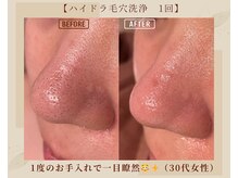 オキシー グレイス 黒崎店(OXY Grace)/ハイドラ毛穴洗浄1回