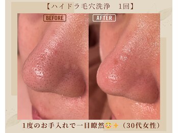 オキシー グレイス 黒崎店(OXY Grace)/ハイドラ毛穴洗浄1回
