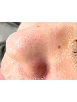 毛穴ケアをしたい