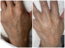 肌育は顔以外にもできる