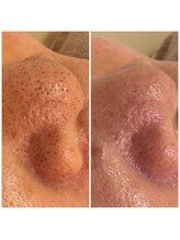 海羽/毛穴汚れスッキリ♪