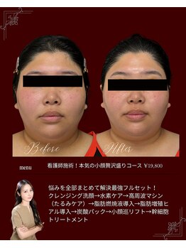 リノン(LIINON)/看護師施術!本気の小顔贅沢盛り