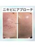 初めてのエステや効果が出る肌改善したい方　初回体験¥11000