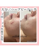 サロンシャイン(Salon Shine)/ハーブピーリングハード2回目