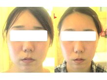 サロンドエステケイワイ(de KY)/フェイシャル☆小顔・タルミ改善