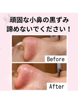 リッチフェイス 京都店(Rich Face)/毛穴洗浄