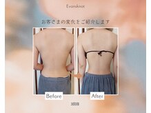 痩身【背中・二の腕】ビフォーアフター。冬の着膨れ対策に！