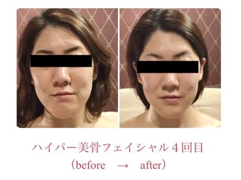 デアルーチェ(DEA LUCE)/小顔矯正+ハイパーナイフ小顔