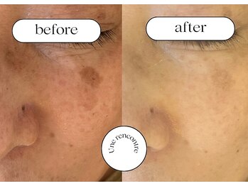 ユヌランコント 岐阜店(Une rencontre)/シミケアマシーン導入店！