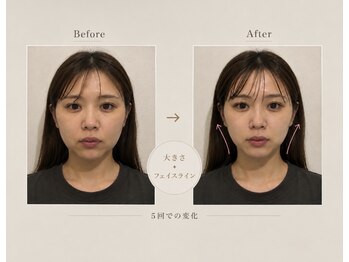 バルーム 北千住店(Baloom)の写真/【人気No.1美容整体】顔左右差&大きさ改善◎骨盤矯正+小顔矯正 ￥15,900→￥2,800 [美容整体/北千住]