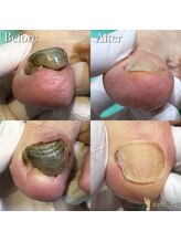 巻き爪補正店 柏店/変形爪・再生補正1指￥5500