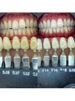 トウキョウスワーズ 池袋店(TOKYO SWRS)/#ホワイトニング #池袋 #渋谷