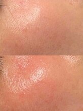 ユウビ ビューティー サロン(Yuubi)/【peel stage】ハーブピーリング