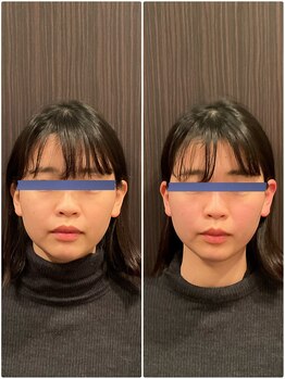 はる鍼灸整骨院/20代女性｜1回の結果