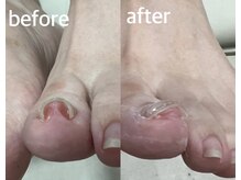 北区天神橋巻き爪センター/巻き爪