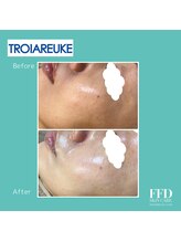 エフエフディースキンケア(FFD SKINCARE)/ピーリング症例