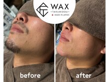 シエルエトワール 唐津店(Ciel Etoile)/匠道ヒゲワックス脱毛
