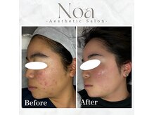 ノア 新宿(Noa)の雰囲気（ハーブピーリング/ニキビケア/毛穴/美肌/ホワイトニング/新宿）