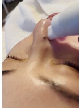 ヘアメイク エステサロン クラシカ(hairmake esthe salon clasika)の写真/毛穴レスなハイドロフェイシャル♪水素×吸引で毛穴の汚れをキレイに◎頭皮ケアもデコルテや背中ケアまで★