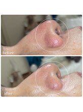 ちらちゅら/ハイドロ毛穴洗浄