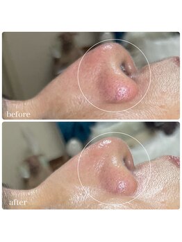 ちらちゅら/ハイドロ毛穴洗浄