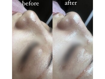 クリアビューティー(CLEAR BEAUTY)/ハイドラフェイシャル