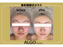 アルゴ 山口宇部店(ALGO)/韓国式エステで悩みの解消へ★