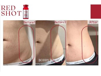 アメリイ 百合ヶ丘 新百合ヶ丘(Amerii)/お腹の脂肪やたるみを引き締め