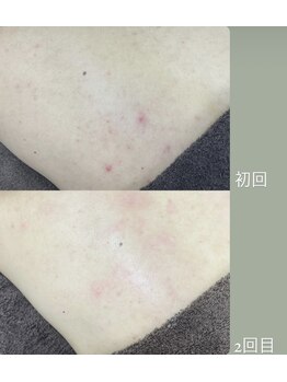 カルディエ(Cardie)/BODYハーブピーリング